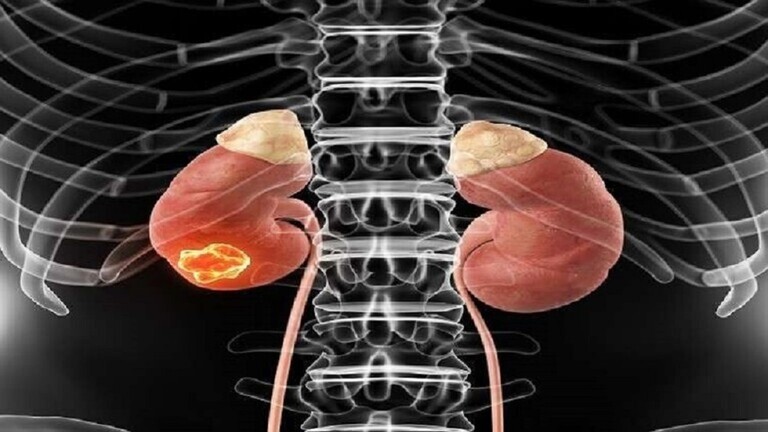 Detecting the first signs of kidney cancer