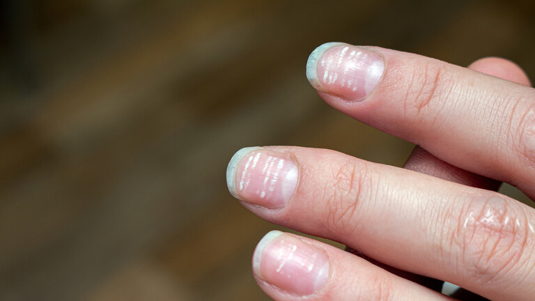 What does the appearance of white marks on the nails mean?