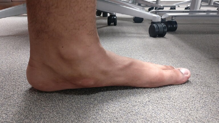 A physician explains the causes of flat toes