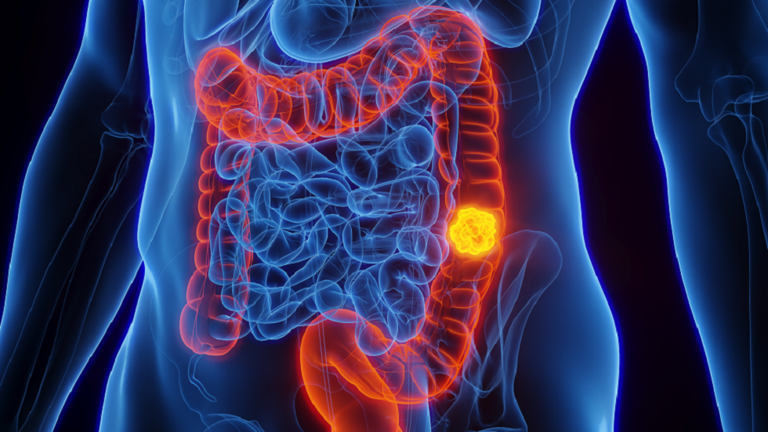 A “killer food regimen” will increase the danger of colon most cancers in younger individuals