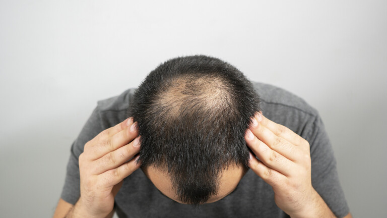 Discovering the “actual” explanation for hair loss guarantees new therapies for baldness