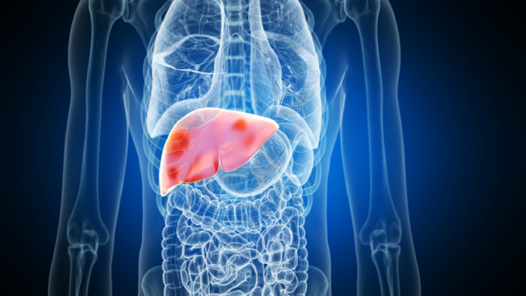 A brand new discovery explains why the loss of life fee is larger amongst lean sufferers with fatty liver illness