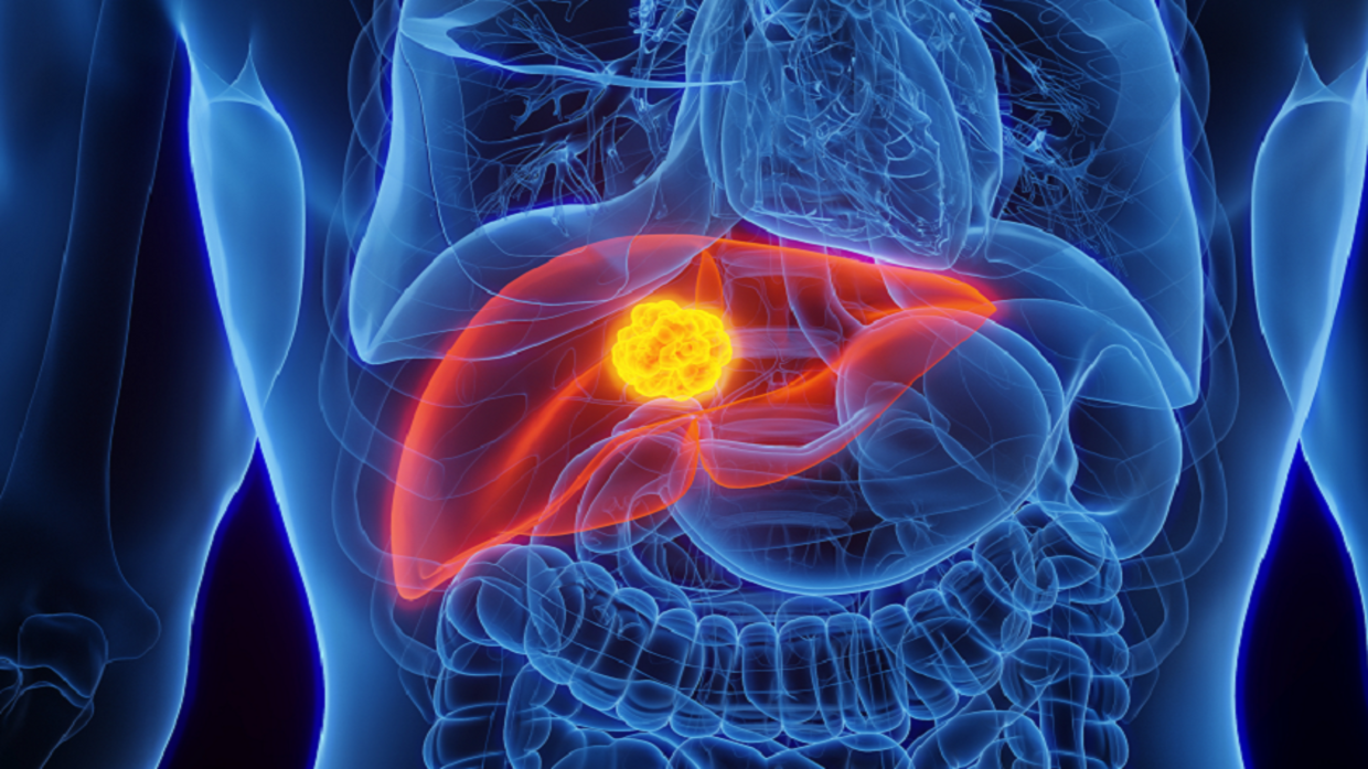 Dietary modification may stop liver cancer growth