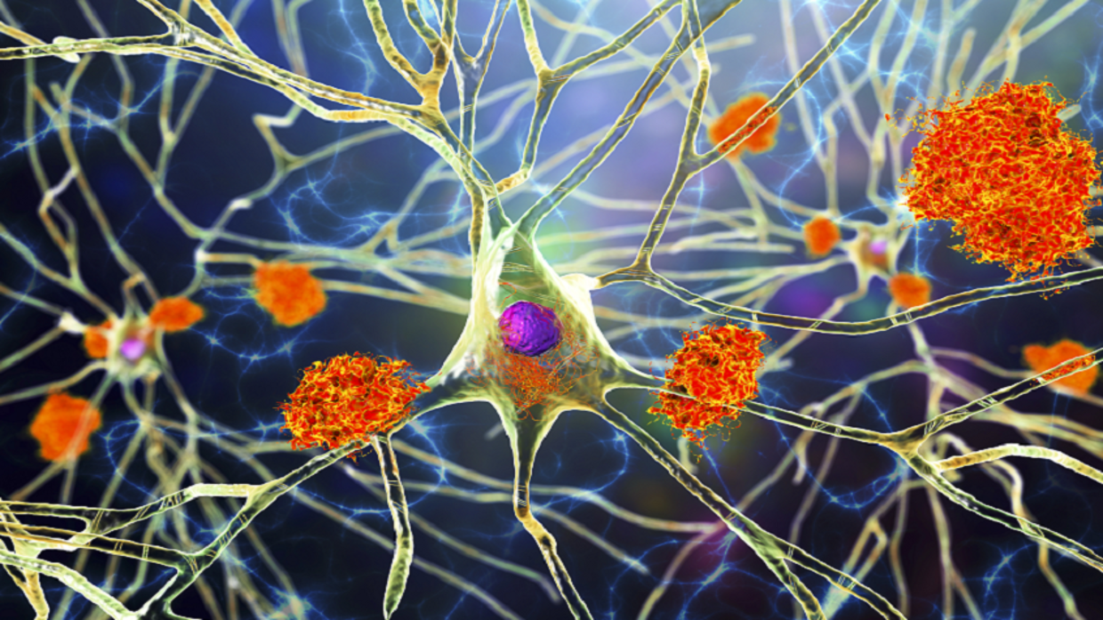 Identifying a link between Alzheimer’s and cancer!